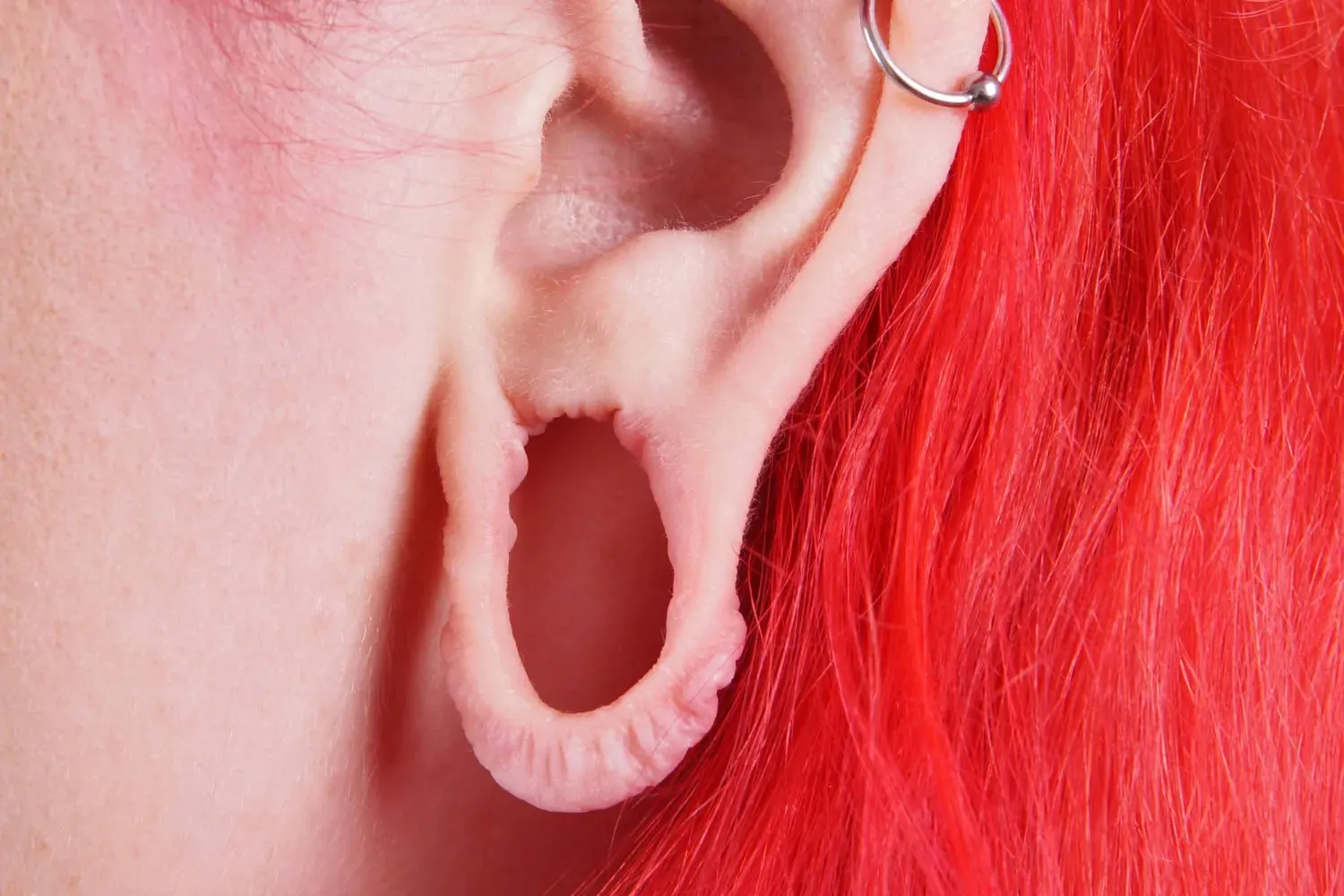 medical dermatology woman stretched-ear-lobe-repair-dermatologist